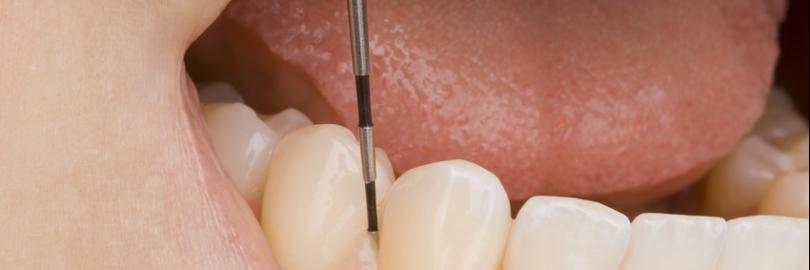 Parodontaler Screening Index (PSI): Messung der Tiefe von Zahntaschen mit einer Messsonde zur Diagnose der Paradontitis