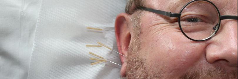 Akupunktur